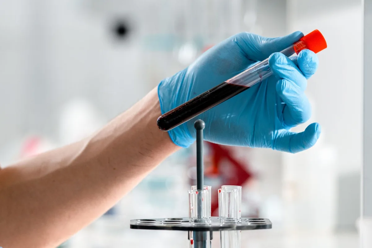 AIIMS Bhopal Advocates for Early Sickle Cell Screening in Pediatrics