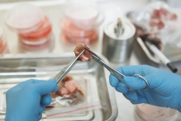 MALDI Imaging Advances Rare Ampullary Cancer Diagnosis