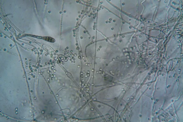 Persistent Alternaria Sensitisation Linked to Asthma Risk