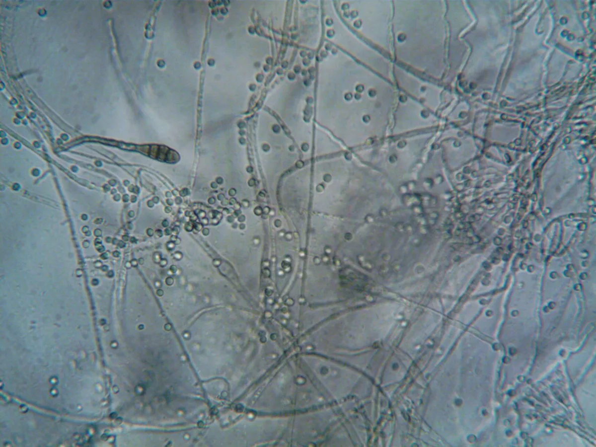 Persistent Alternaria Sensitisation Linked to Asthma Risk