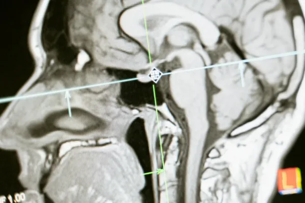 The Quest to Prevent Post-Traumatic Epilepsy: New Frontiers in Brain Injury Research