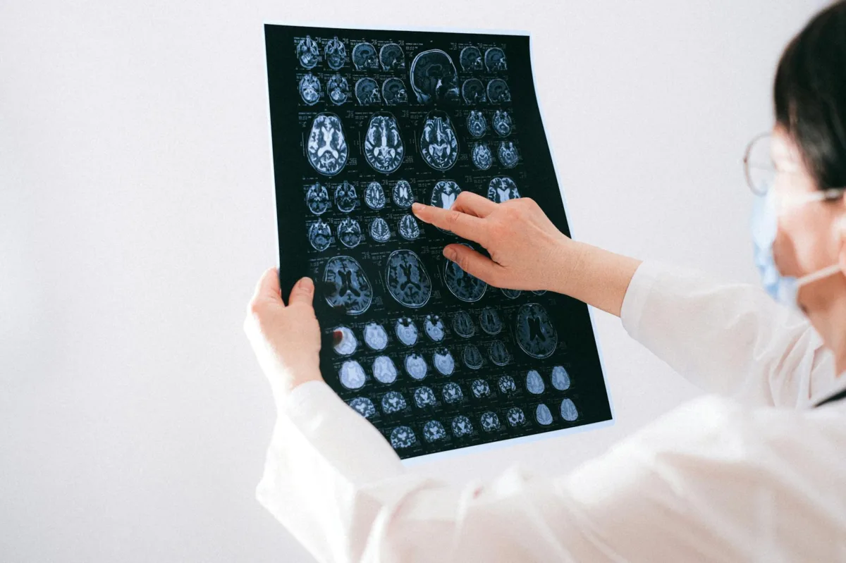 Rising Brain Tumour Diagnoses in Younger Populations Prompt Medical Caution